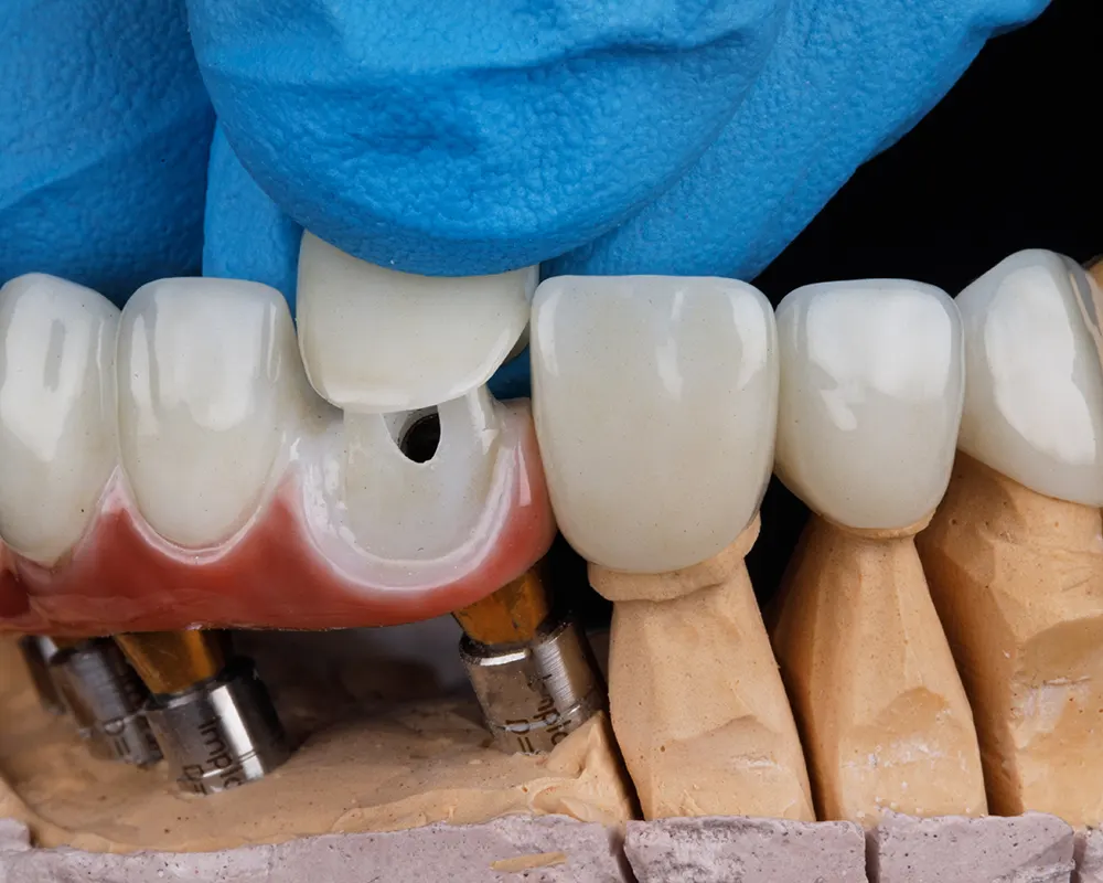 Cost, insurance, and payment plans for crowns and bridges in katy