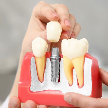 What Is Full Mouth Dental Implants Treatment