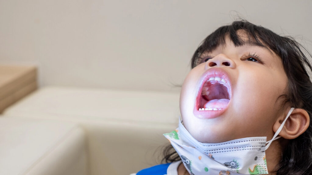Common tongue tie symptoms in childrens Common tongue tie symptoms in children