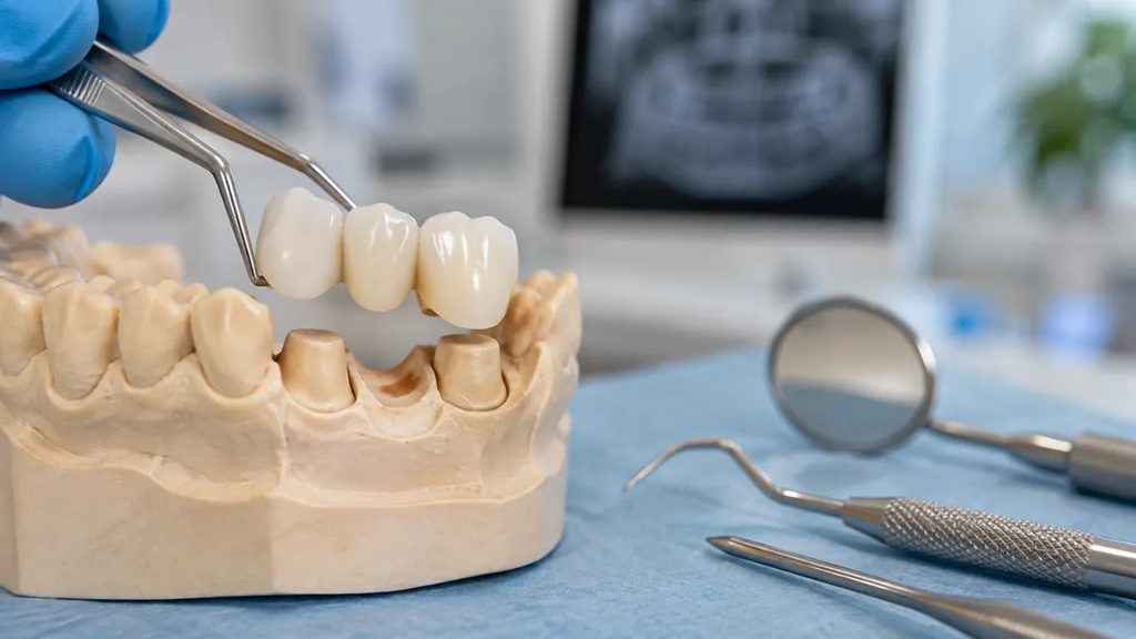 Dental bridge cost per tooth Dental bridge cost per tooth