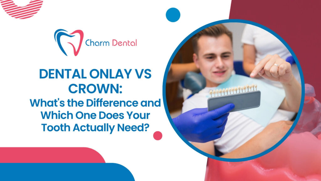 Dental onlay vs crown: what's the difference and which one does your tooth actually need?