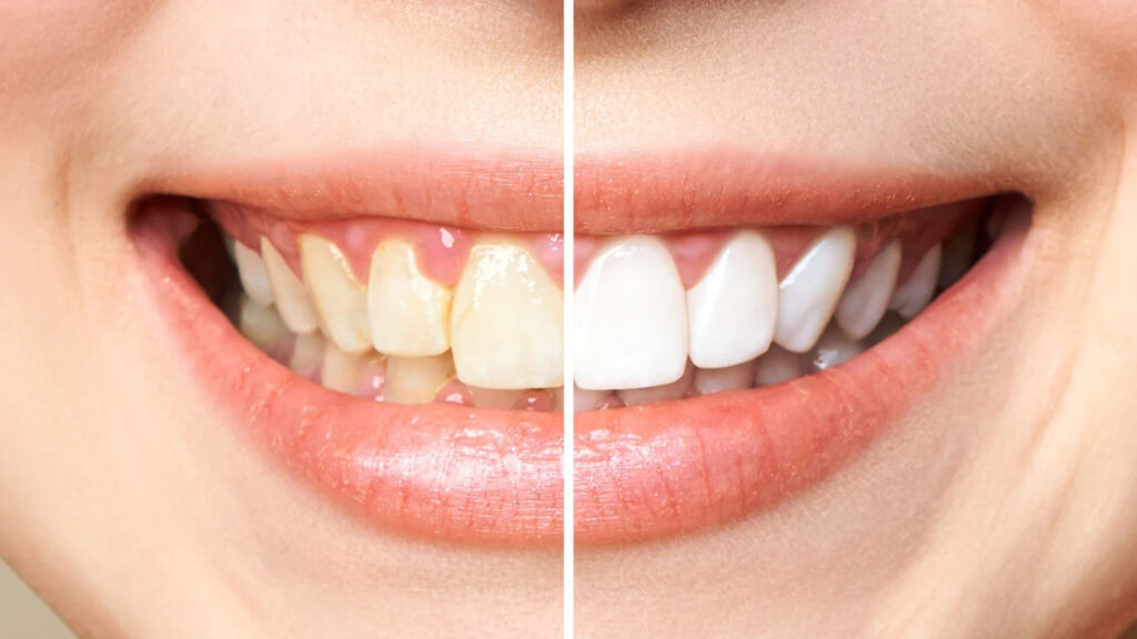 Does coconut oil whiten teethh Does coconut oil whiten teeth