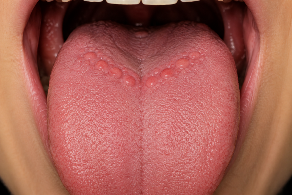 Enlarged circumvallate papillae