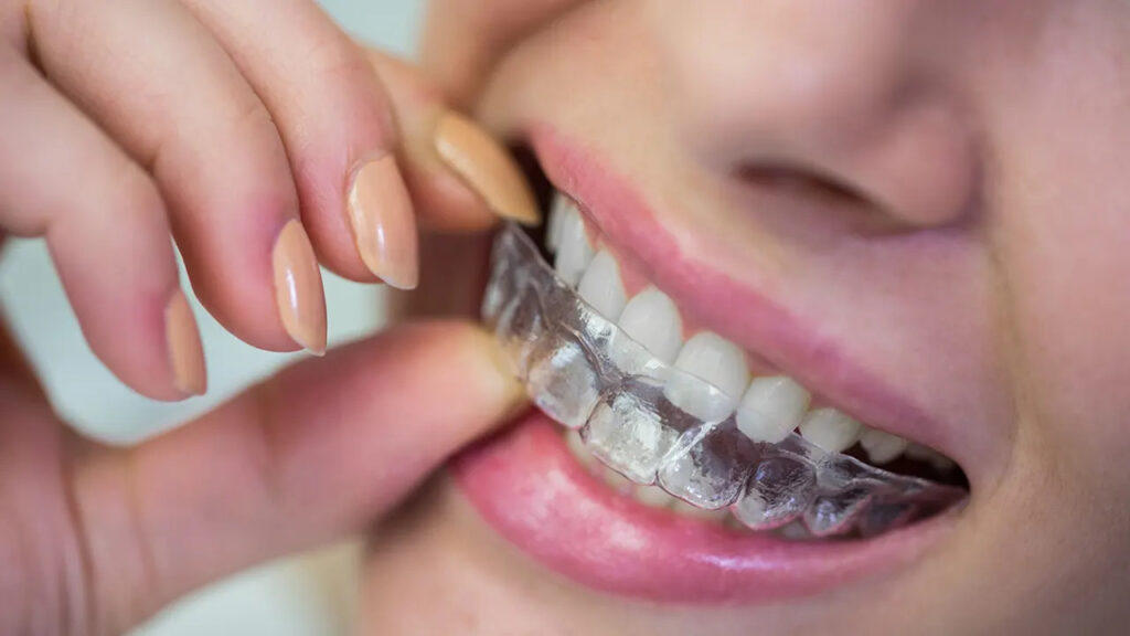 Hidden invisalign costs to know: retainers and replacements