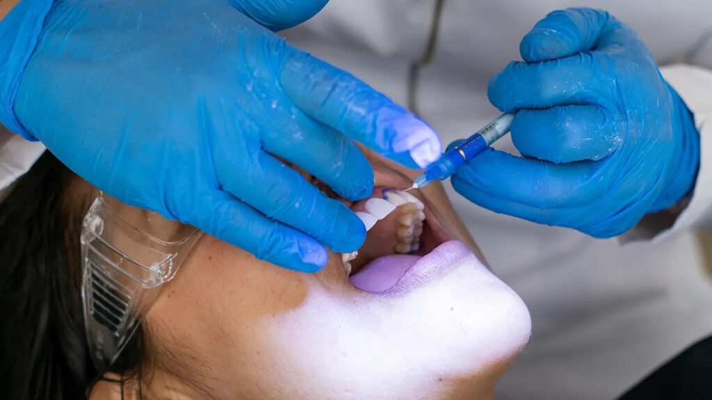 How do dental sealants work to prevent 80% cavities in adults?