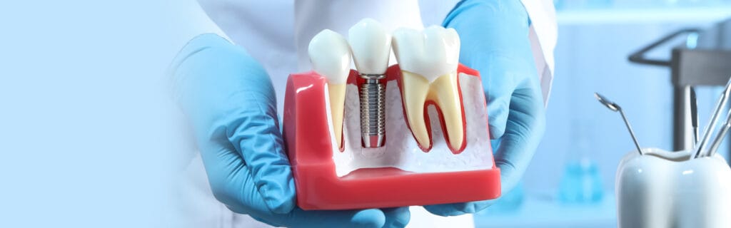 Dental implants treatment in spring, tx