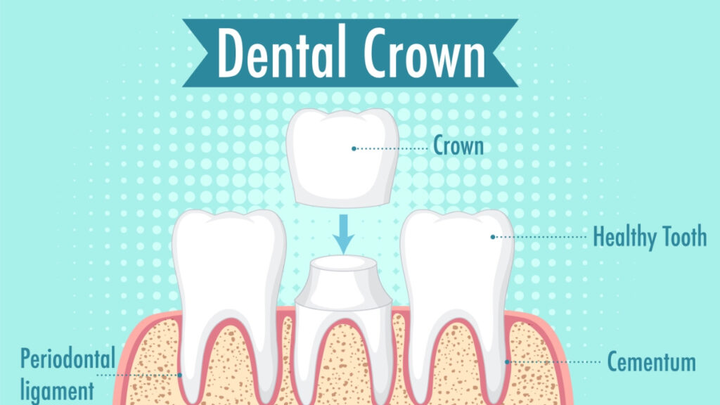 Onlay vs crown: side-by-side comparison (strength, tooth preservation, cost)