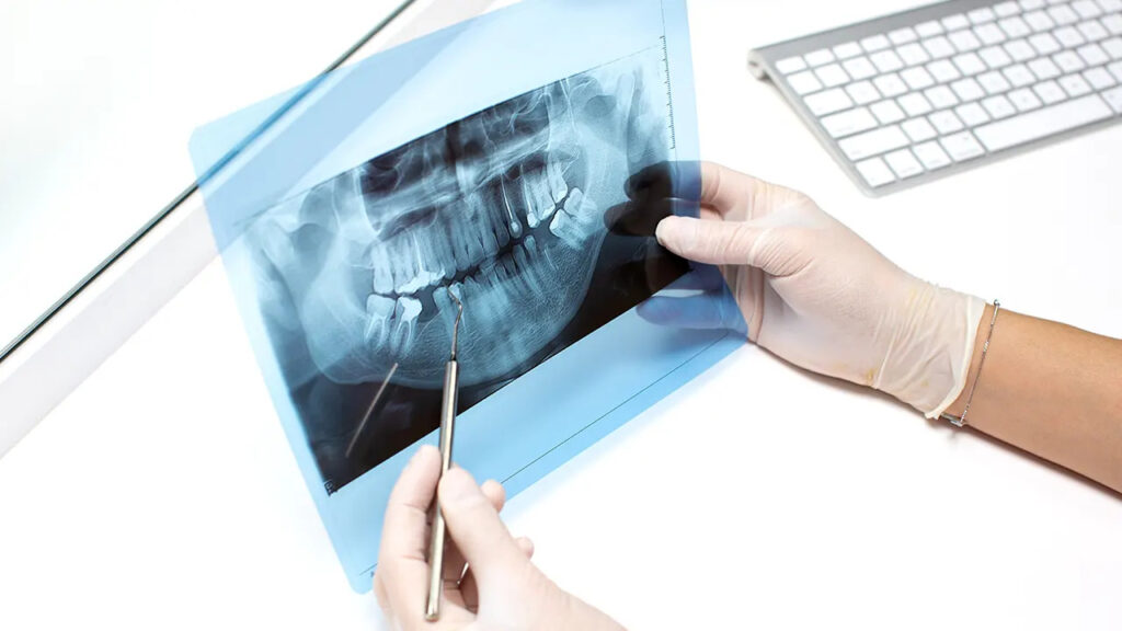 Same-day vs delayed implants: is “teeth in a day” right for you?