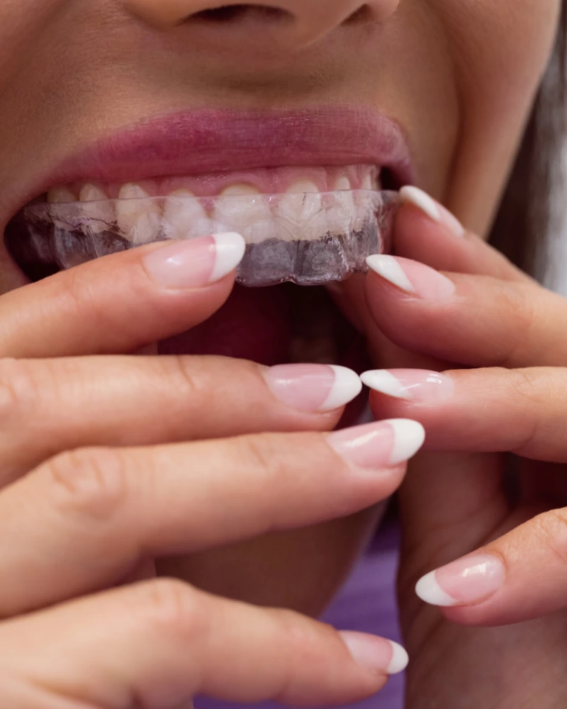 Sports mouth guard costs