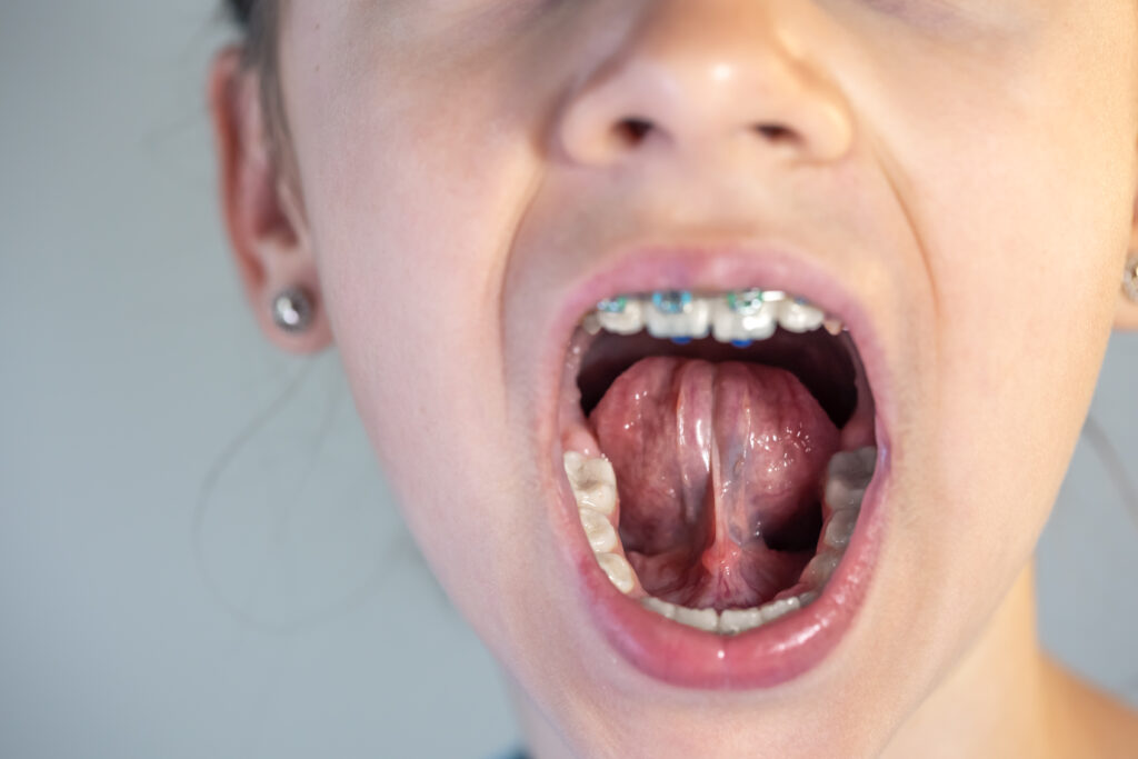 Tongue tie What is tongue tie?