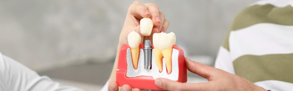 What is full mouth dental implants