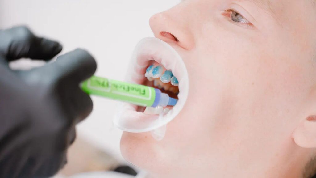 What types of dental sealants are used for adults