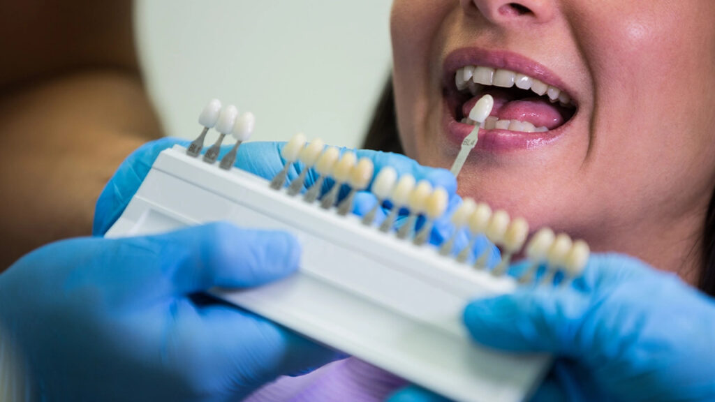 When do you need a dental crown When do you need a dental crown?