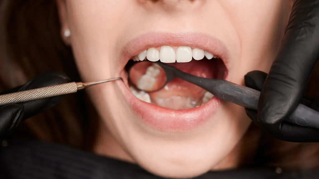 Who is a good candidate for dental sealants as an adult?