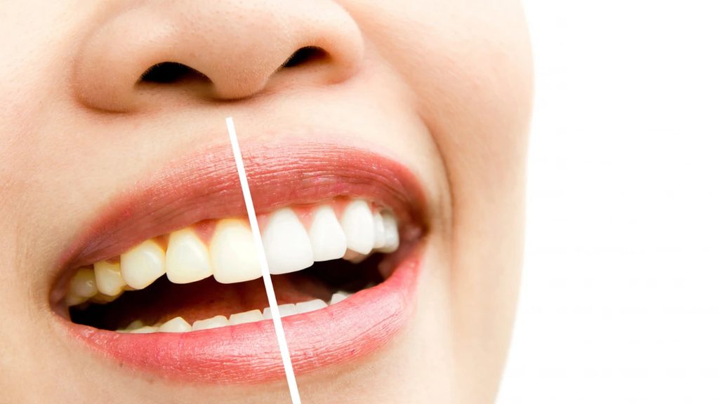 Why are my teeth yellow or discolored Why are my teeth yellow or discolored?