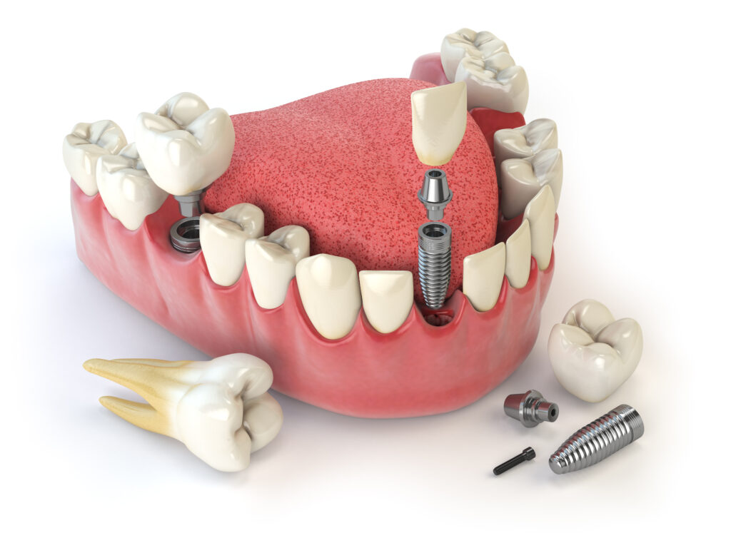 Dental implants