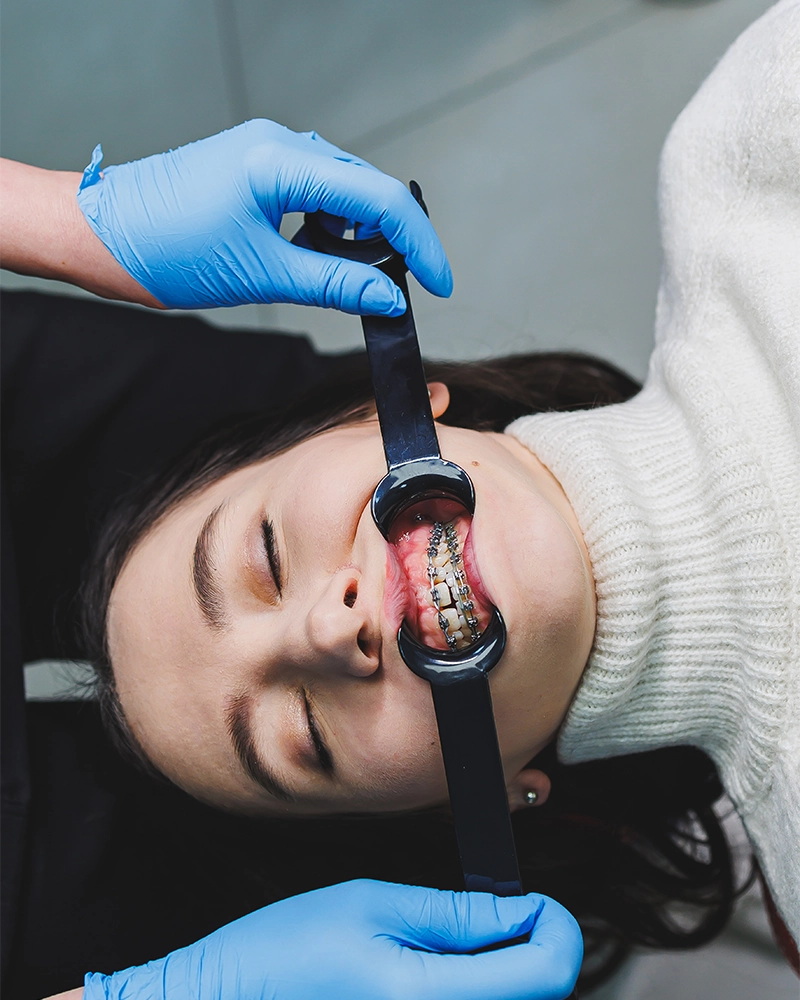 Fast braces1
