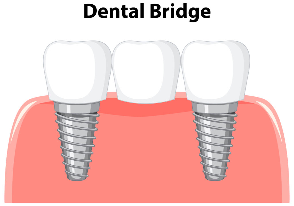 Dental bridge