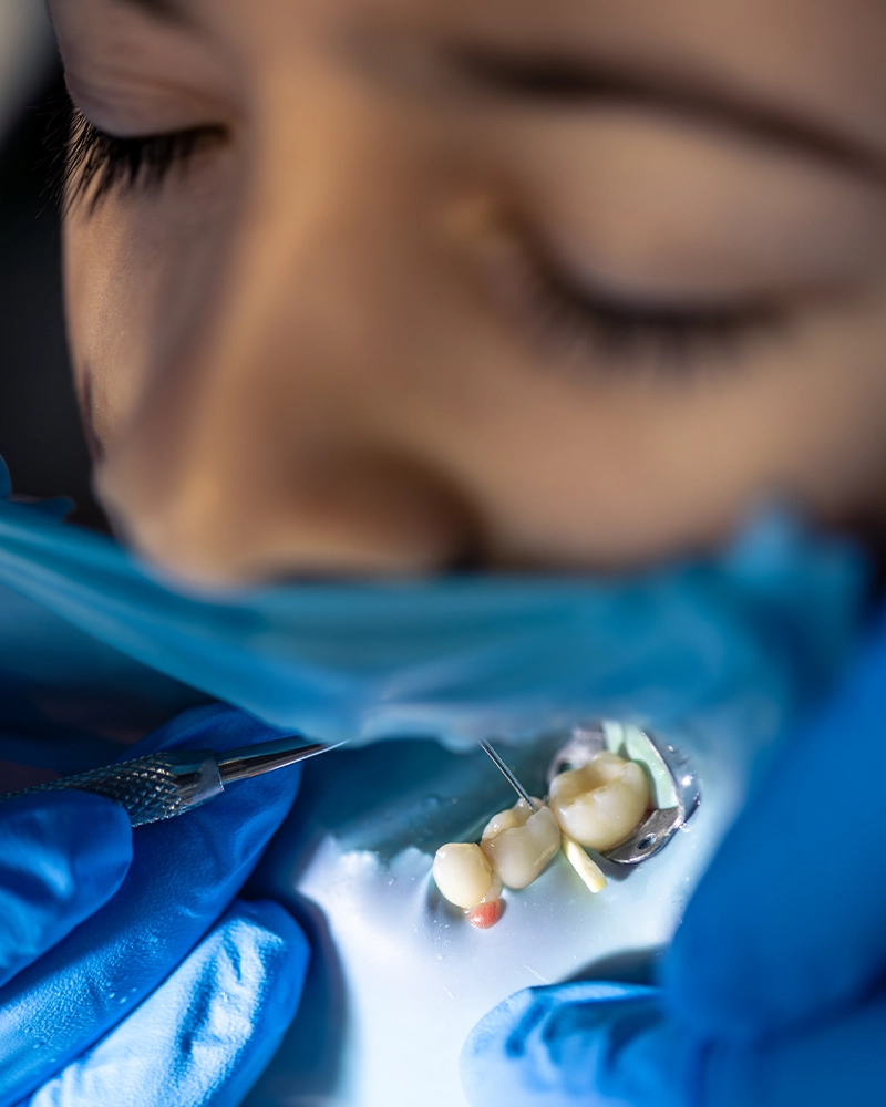 Wisdom tooth removal